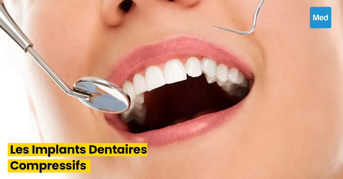Sourire Confiant : Tout ce que Vous Devez Savoir sur les Implants Dentaires Compressifs